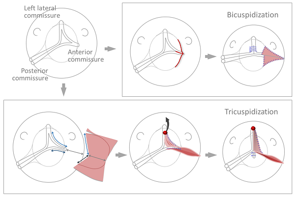 Tricuspidization by the raphe suspension technique in a unicuspid or ...